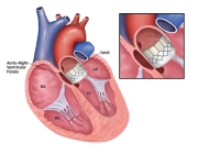 JACC-Case-Reports-Patterson-Redwood-CI-January2020