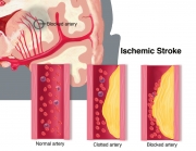 Ischemic Stroke