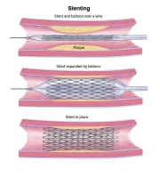 Interventional-Radiology-1