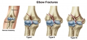 Elbow Fractures