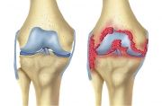 Normal Kneee & Knee With Rheumatoid Arthritis