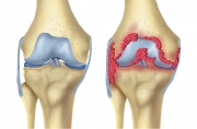 Normal Kneee & Knee With Rheumatoid Arthritis