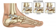 Ankle Spr