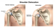 Shoulder Dislocation