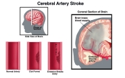 Hultman-stroke