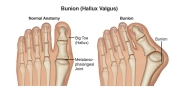 Physical-Therapy-1